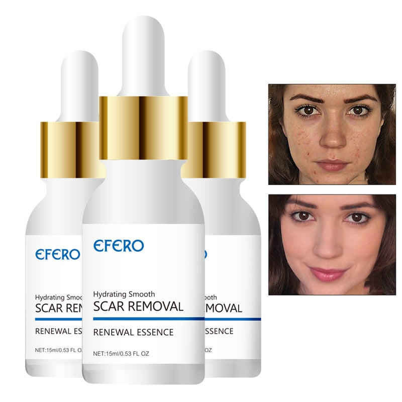 Face Serum Essence Against Black Dot Cream Acne Scar Blackhead Spots Skin Care